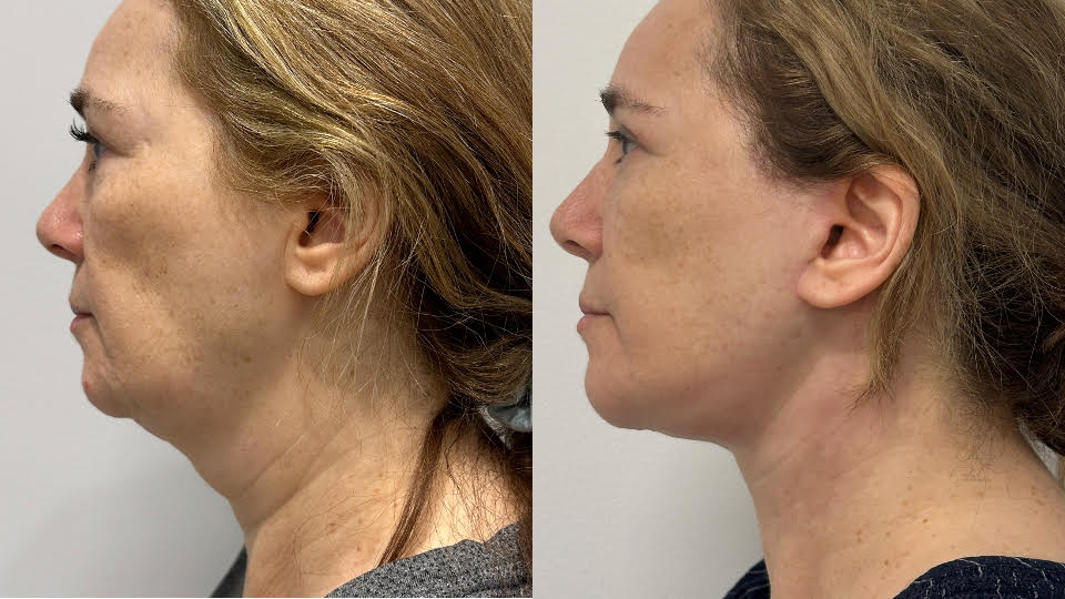 Actual Patient 2 Months Post-Op