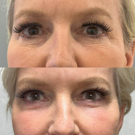 Deep Plane Facelift case #4116