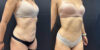Tummy Tuck case #4098 slider thumbnail