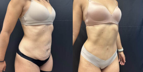 Tummy Tuck case #4098