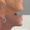 Deep Plane Facelift case #4116 slider thumbnail