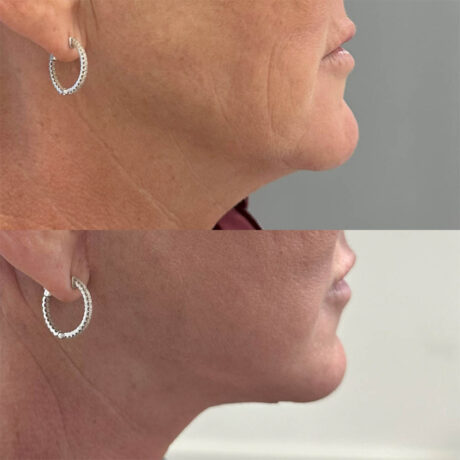 Deep Plane Facelift case #4116