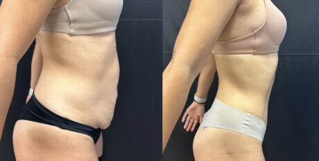 Tummy Tuck case #4098