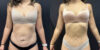 Tummy Tuck case #4098 slider thumbnail