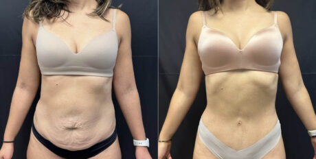Tummy Tuck case #4098