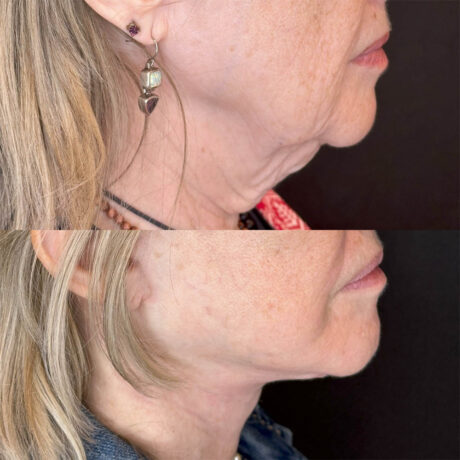 Deep Plane Facelift case #4121