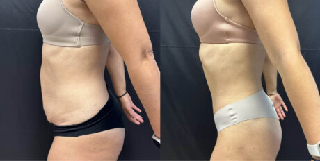 Tummy Tuck case #4098