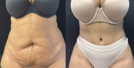 Tummy Tuck case #4103