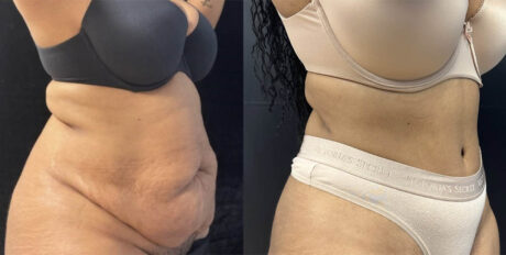 Tummy Tuck case #4103