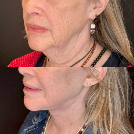 Deep Plane Facelift case #4121