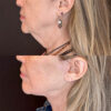 Deep Plane Facelift case #4121 slider thumbnail
