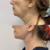 Deep Plane Facelift case #4128 slider thumbnail