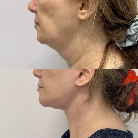 Deep Plane Facelift case #4128