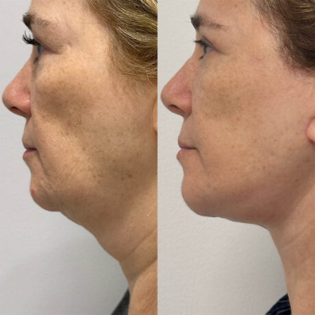 Deep Plane Facelift case #4128