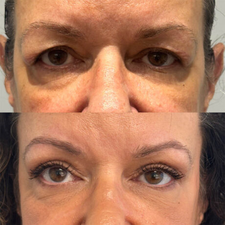 Upper Blepharoplasty case #4089
