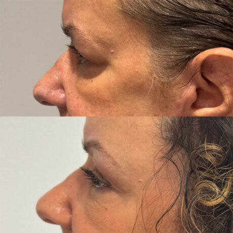 Upper Blepharoplasty case #4089