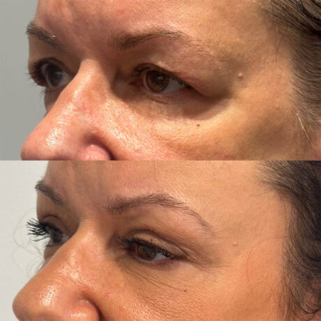 Upper Blepharoplasty case #4089