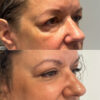 Upper Blepharoplasty case #4089 slider thumbnail
