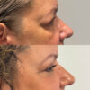 Upper Blepharoplasty case #4089 slider thumbnail
