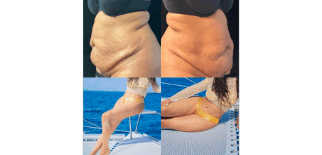 Tummy Tuck case #4103