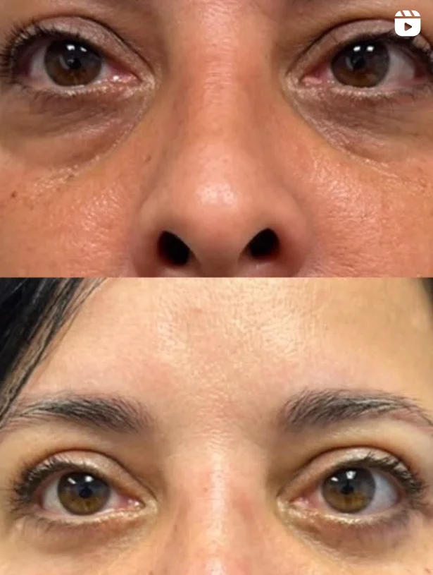 blepharoplasty
