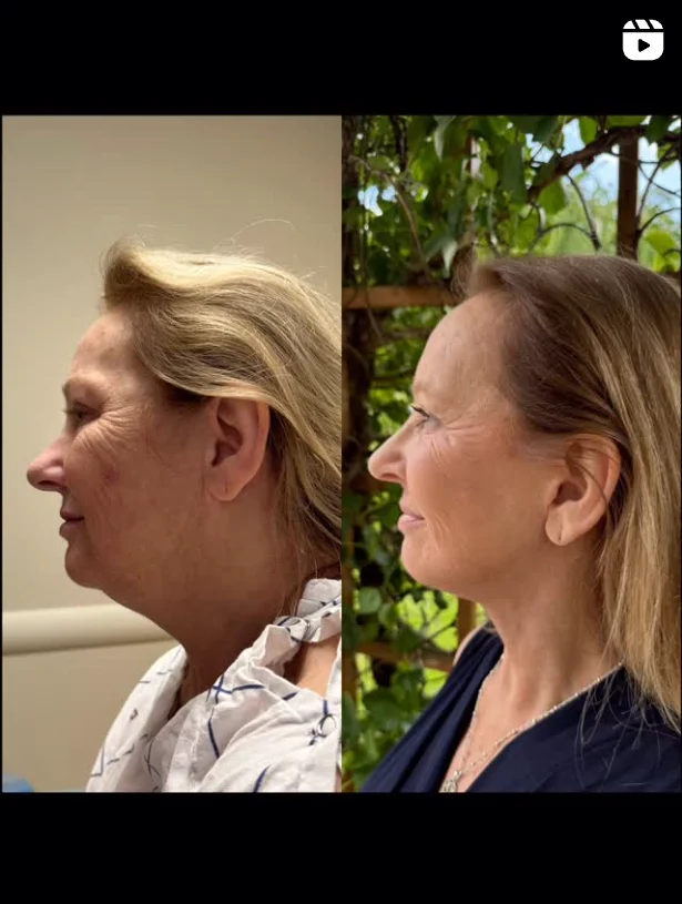 deep-plane-facelift