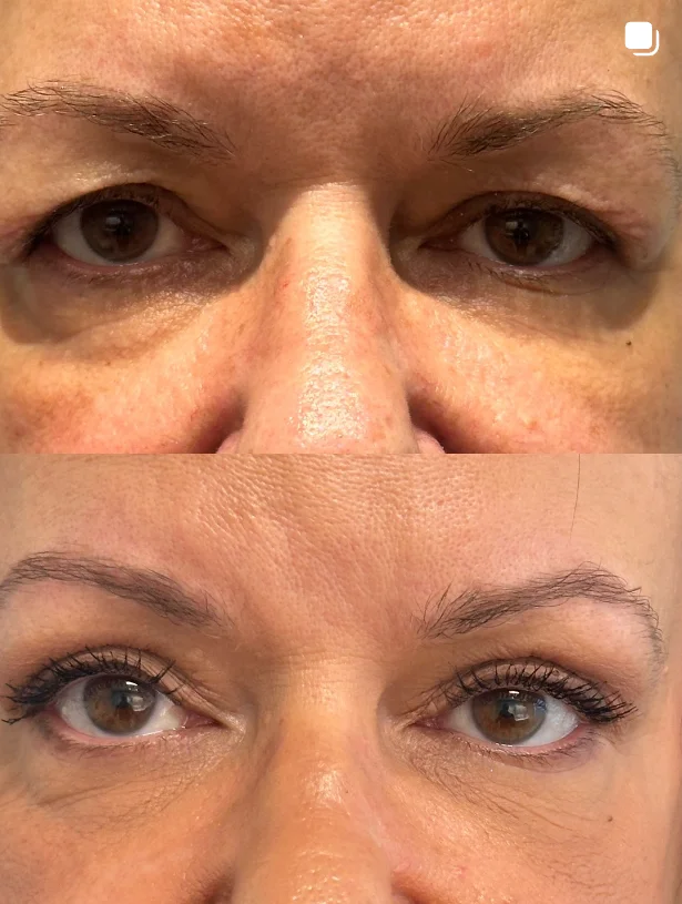 eyelid-surgery