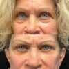 Lower Blepharoplasty case #4115 slider thumbnail