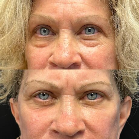 Lower Blepharoplasty case #4115