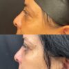 Lower Blepharoplasty case #4114 slider thumbnail