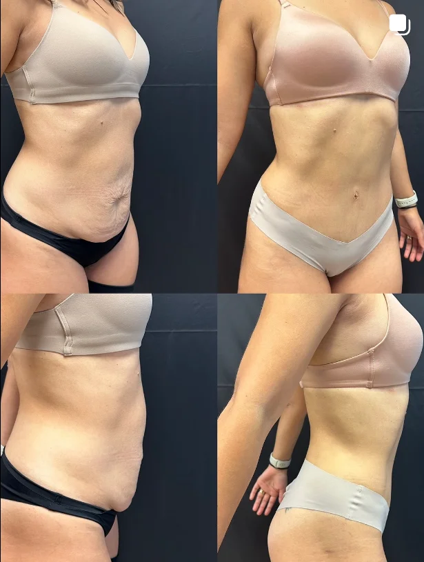 tummy-tuck