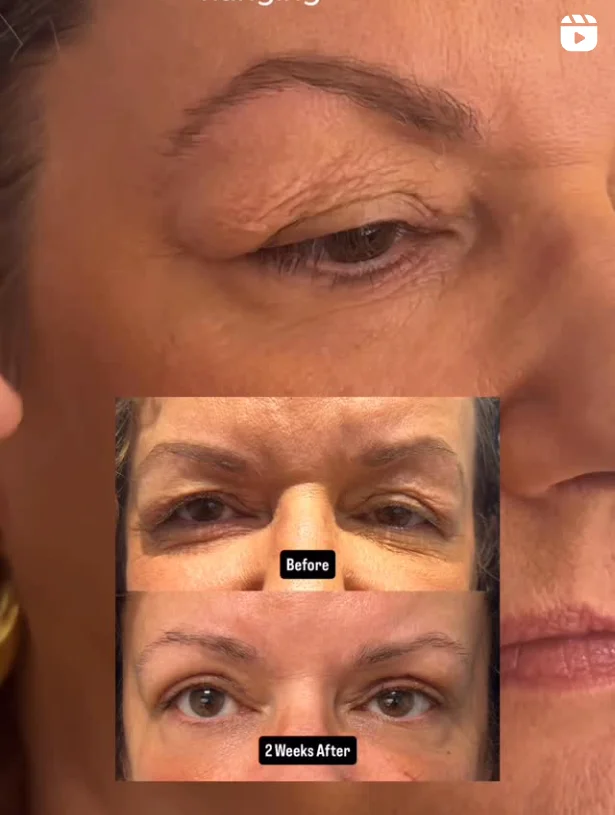 upper-eyelid