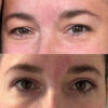 Upper Blepharoplasty case #4083 slider thumbnail