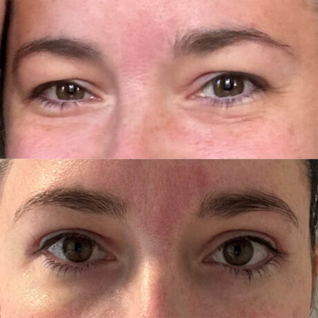 Upper Blepharoplasty case #4083
