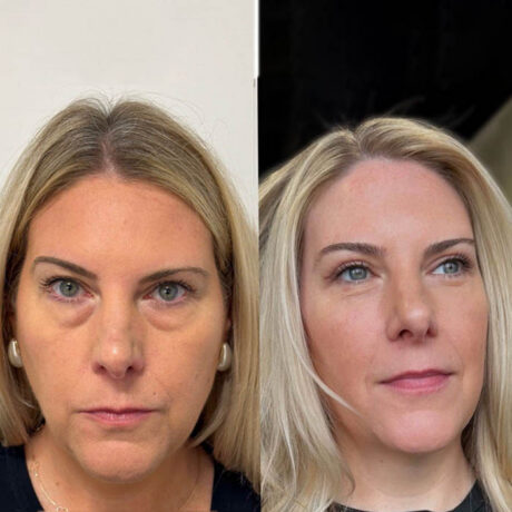 Eyelid & Brow Lift case #6284