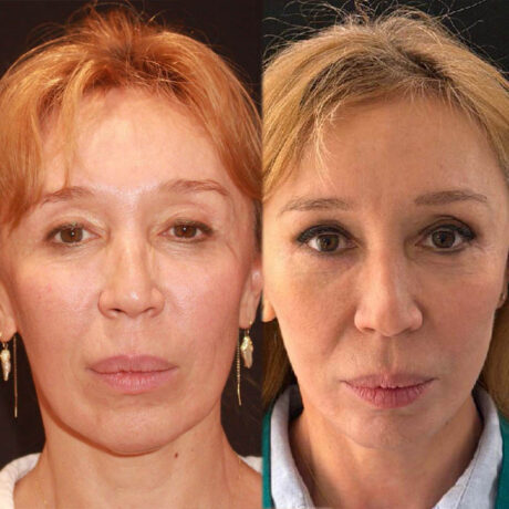 Deep Plane Facelift case #6276