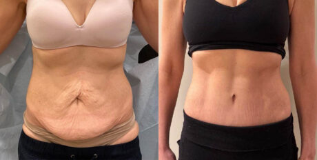 Tummy Tuck case #6356