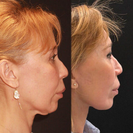 Deep Plane Facelift case #6276