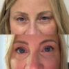 Eyelid & Brow Lift case #6286 slider thumbnail