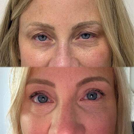 Eyelid & Brow Lift case #6286