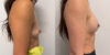 Breast Augmentation case #6294 slider thumbnail
