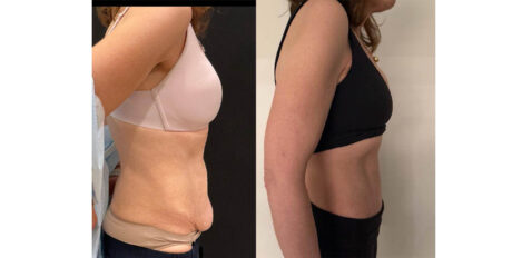 Tummy Tuck case #6356