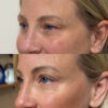 Eyelid & Brow Lift case #6288