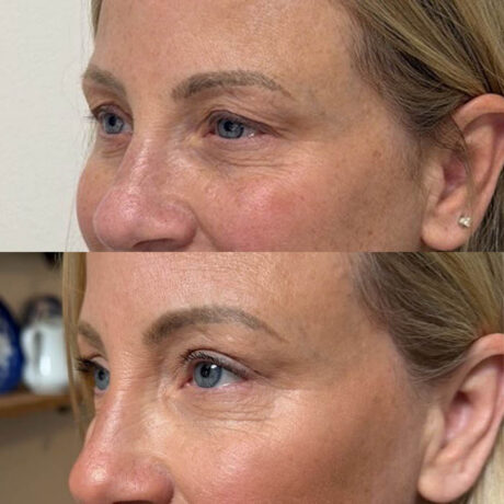 Eyelid & Brow Lift case #6288