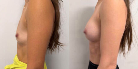 Breast Augmentation case #6294