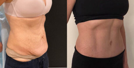 Tummy Tuck case #6356