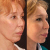 Deep Plane Facelift case #6276 slider thumbnail