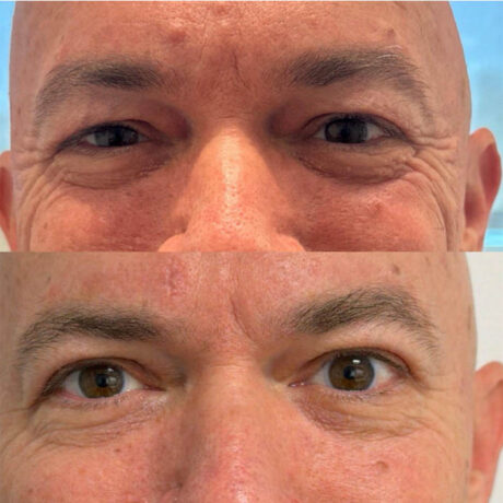 Eyelid & Brow Lift case #6290