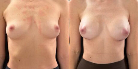 Breast Augmentation case #6298