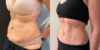 Tummy Tuck case #6356 slider thumbnail